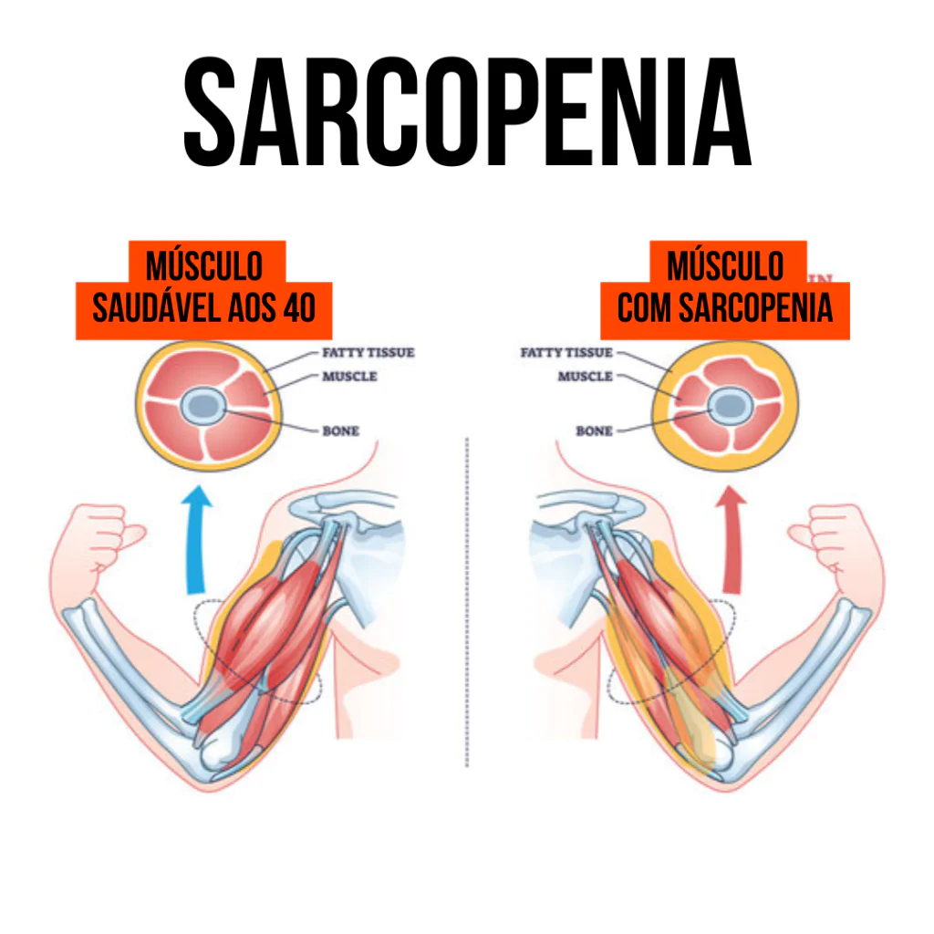 A imagem demostra como ficar o músculo de alguem com 40 anos saudável ou com 40 anos com sarcopenia